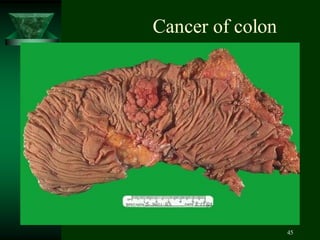 45
Cancer of colon
 