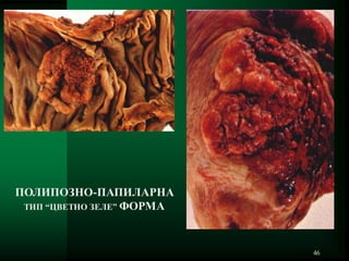 46
ПОЛИПОЗНО-ПАПИЛАРНА
ТИП “ЦВЕТНО ЗЕЛЕ” ФОРМА
 
