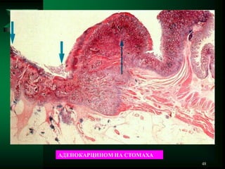 48
АДЕНОКАРЦИНОМ НА СТОМАХА
 