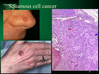 50
Squamous cell cancer
 