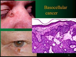 51
Basocellular
cancer
 