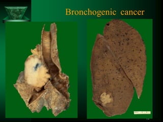 52
Bronchogenic cancer
 