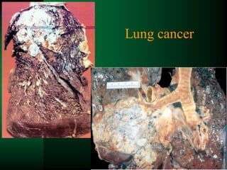 53
Lung cancer
 