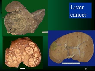 54
Liver
cancer
 