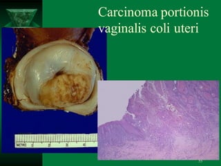 55
Carcinoma portionis
vaginalis coli uteri
 