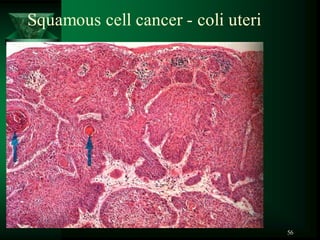56
Squamous cell cancer - coli uteri
 