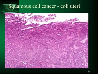57
Squamous cell cancer - coli uteri
 