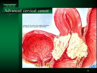 58
Advanced cervical cancer
 