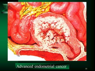 59
Advanced endometrial cancer
 