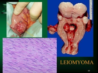 60
LEIOMYOMA
 
