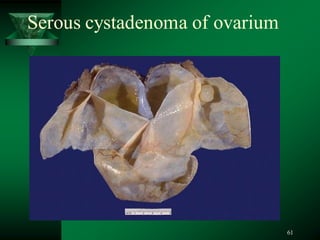61
Serous cystadenoma of ovarium
 