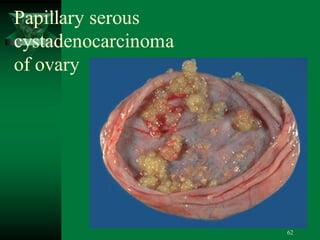 62
Papillary serous
cystadenocarcinoma
of ovary
 