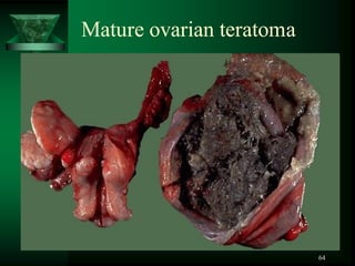 64
Mature ovarian teratoma
 