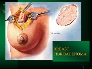 66
BREAST
FIBROADENOMA
 