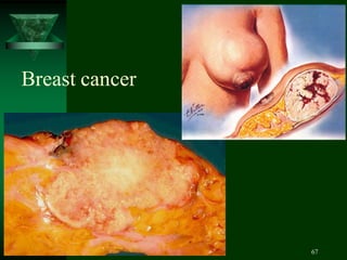 67
Breast cancer
 