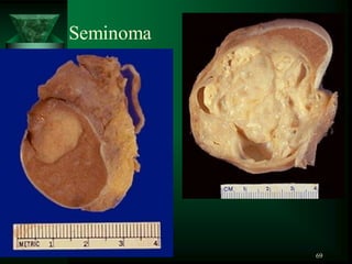 69
Seminoma
 