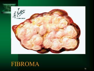 70
FIBROMA
 