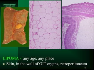71
LIPOMA - any age, any place
 Skin, in the wall of GIT organs, retroperitoneum
 
