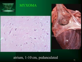 73
atrium, 1-10 cm, pedunculated
MYXOMA
 