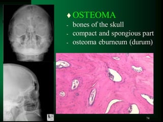 74
 OSTEOMA
- bones of the skull
- compact and spongious part
- osteoma eburneum (durum)
 