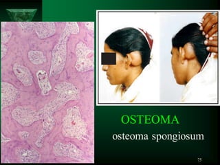 75
OSTEOMA
osteoma spongiosum
 