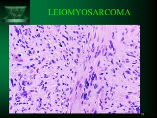 78
LEIOMYOSARCOMA
 