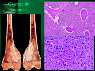 80
Osteogenic
Sarcoma
 