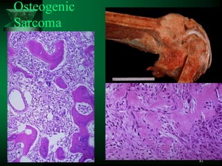 81
Osteogenic
Sarcoma
 