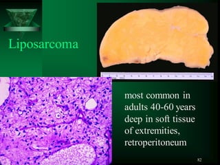 82
most common in
adults 40-60 years
deep in soft tissue
of extremities,
retroperitoneum
Liposarcoma
 