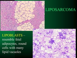 83
LIPOSARCOMA
LIPOBLASTS –
resemble fetal
adipocytes, round
cells with many
lipid vacuoles
 