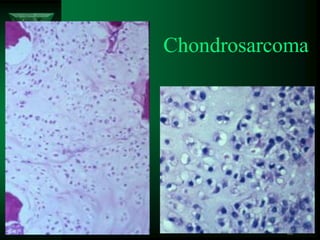 85
Chondrosarcoma
 