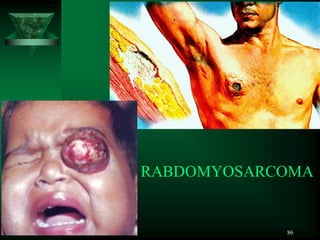 86
RABDOMYOSARCOMA
 