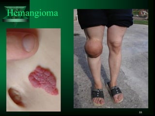 88
Hemangioma
 