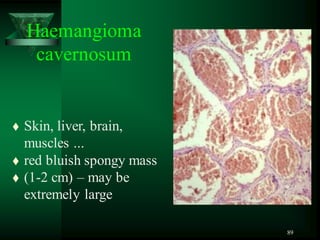 89
Haemangioma
cavernosum
 Skin, liver, brain,
muscles ...
 red bluish spongy mass
 (1-2 cm) – may be
extremely large
 