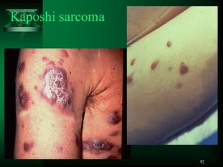 92
Kaposhi sarcoma
 