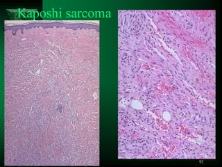 93
Kaposhi sarcoma
 