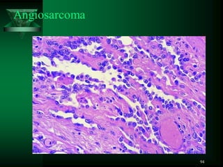 94
Angiosarcoma
 