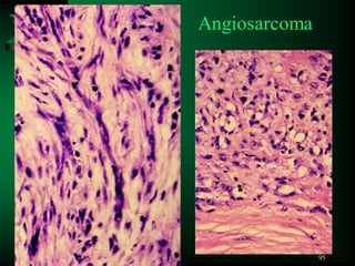 95
Angiosarcoma
 
