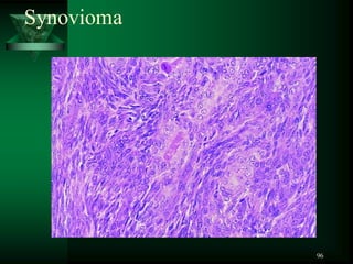 96
Synovioma
 