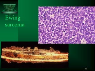 99
Ewing
sarcoma
 