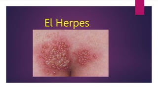 El Herpes
 