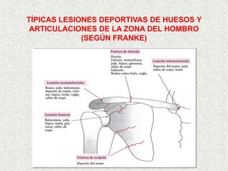 TÍPICAS LESIONES DEPORTIVAS DE HUESOS Y
 ARTICULACIONES DE LA ZONA DEL HOMBRO
             (SEGÚN FRANKE)
 