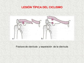 LESIÓN TÍPICA DEL CICLISMO




Fractura de clavícula y separación de la clavícula
 