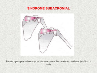 SÍNDROME SUBACROMIAL




Lesión típica por sobrecarga en deporte como lanzamiento de disco, jabalina y
                                     tenis
 