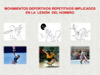 MOVIMIENTOS DEPORTIVOS REPETITIVOS IMPLICADOS
          EN LA LESIÓN DEL HOMBRO
 
