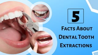 Facts About
Dental Tooth
Extractions
5
 