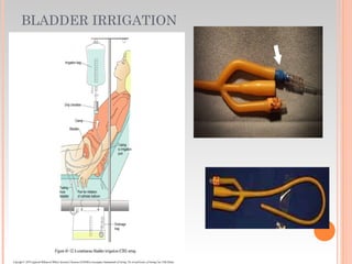 BLADDER IRRIGATION
 