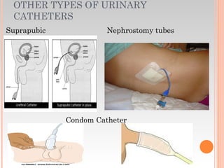 OTHER TYPES OF URINARY
CATHETERS
Suprapubic Nephrostomy tubes
Condom Catheter
 