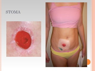 STOMA
 