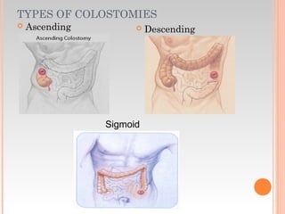 TYPES OF COLOSTOMIES
 Ascending  Descending
Sigmoid
 